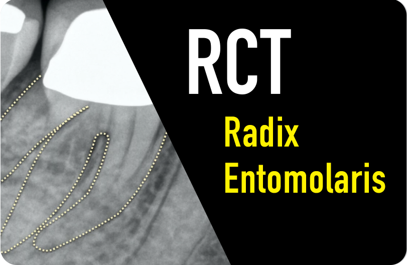 Root Canal Treatment: Entomolaris