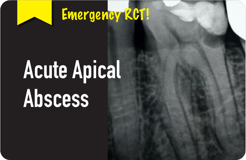 Emergency Root Canal Treatment