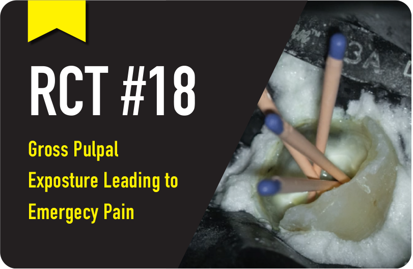 Gross Pulpal Exposure Leading to Emergency Pain