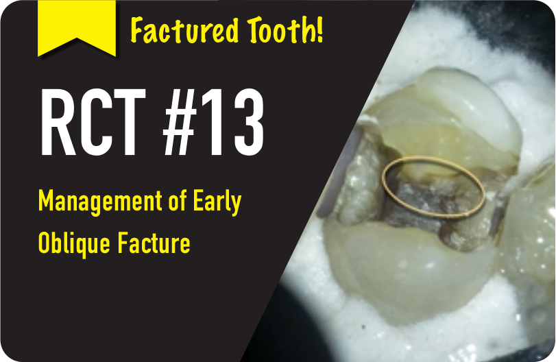 Management of and Early Oblique Fracture