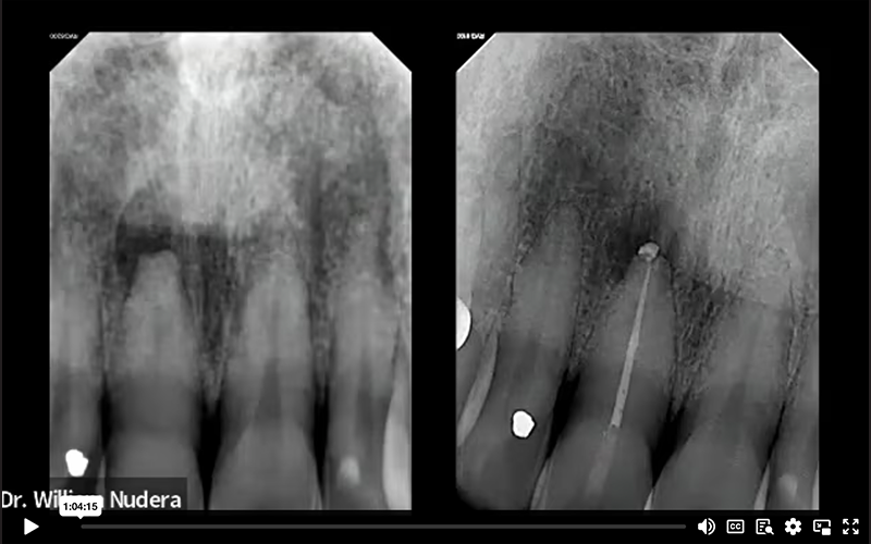 Receded Pulp Chamber in Maxillary Central Incisor