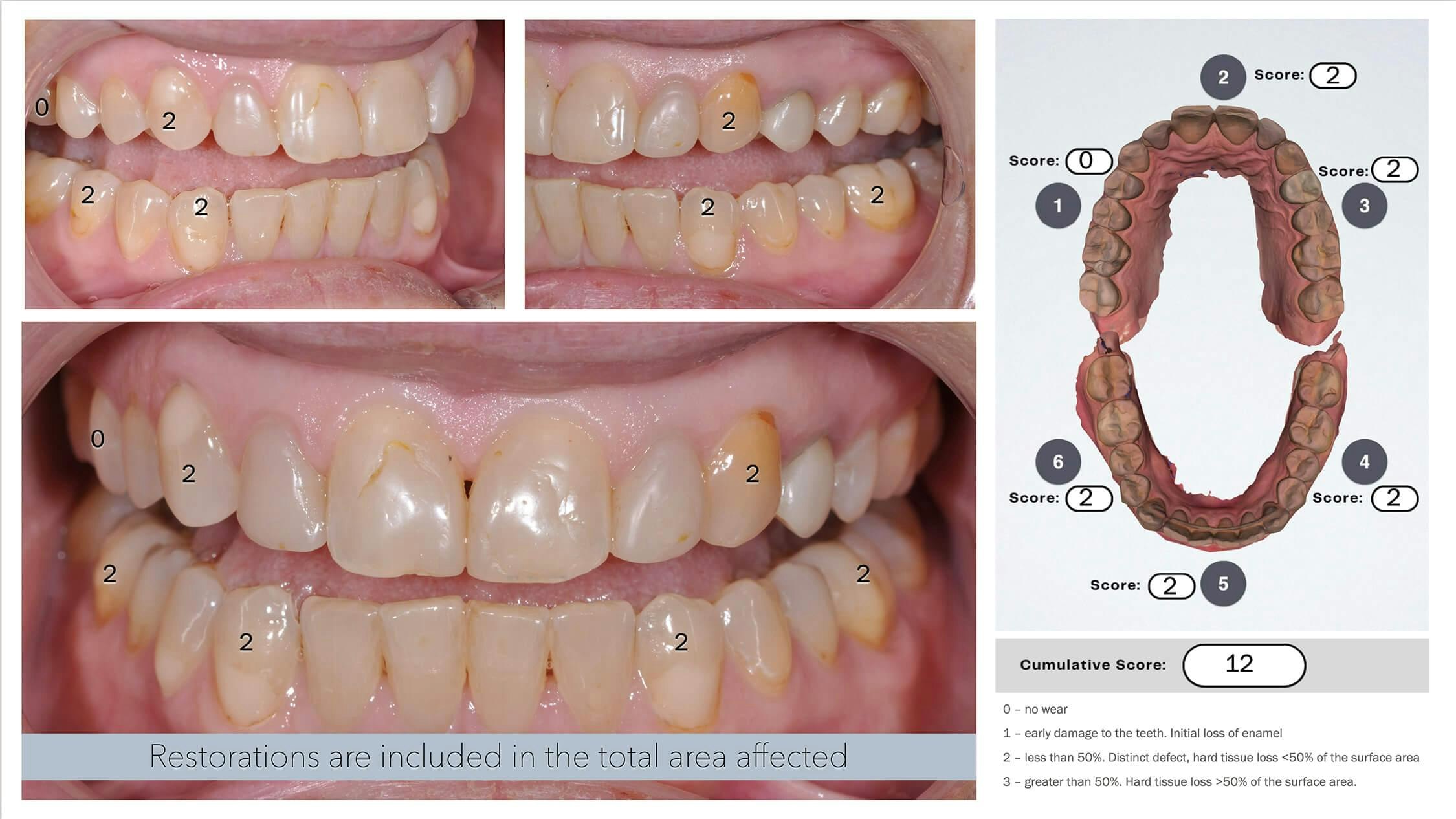 Measuring Tooth Wear: How To Use a Simple Index - The New Dentist