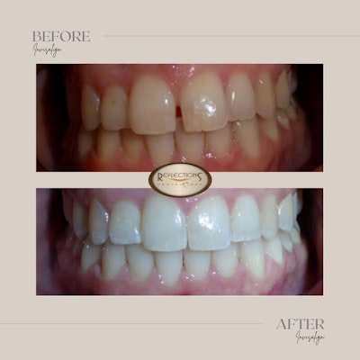a patient before and after photograph of invisalign procedure