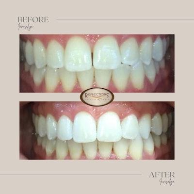 a patient smiling before and after photograph of invisalign treatment