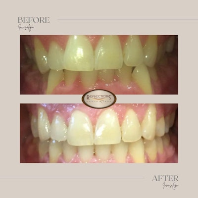 a patient before and after photograph of invisalign