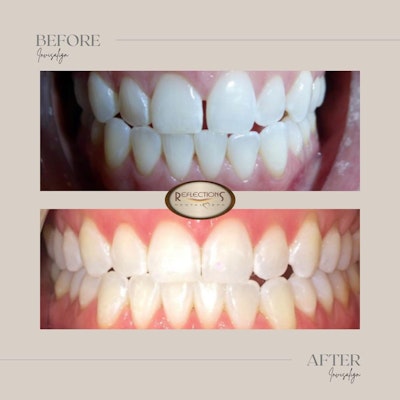 a patient before and after photograph of invisalign treatment