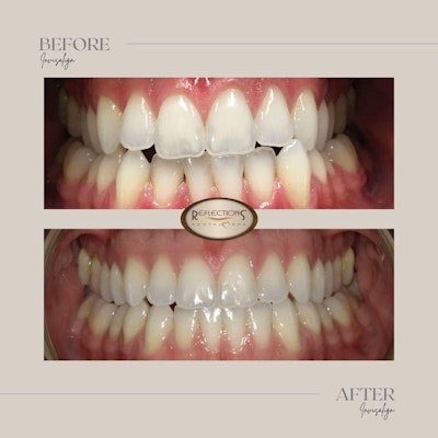 a patient smiling before and after photograph of invisalign treatment