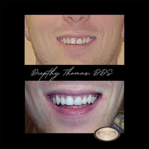 a close up of mouth from male patient before and after treatment