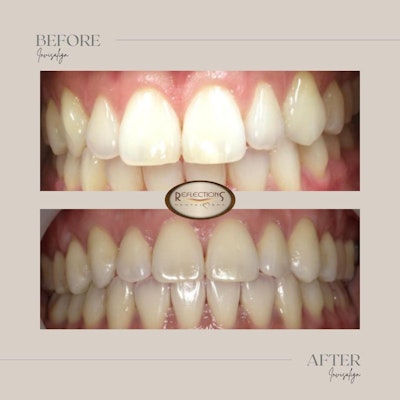 before and after photograph of invisalign procedure