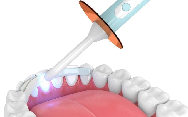 illustration of dental bonding