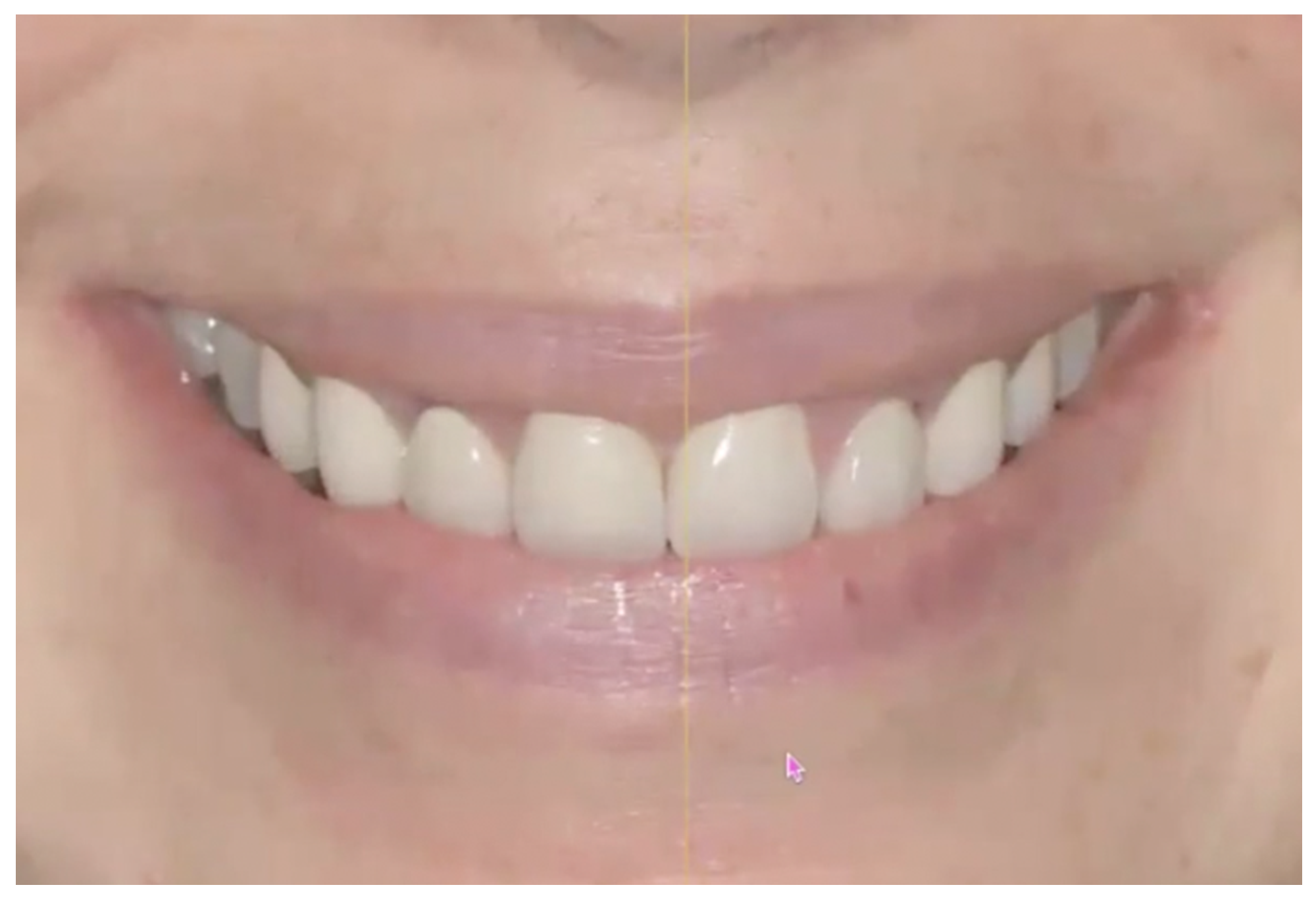 Comprehensive Consultation for Maxillary Restorations and Smile Transformation