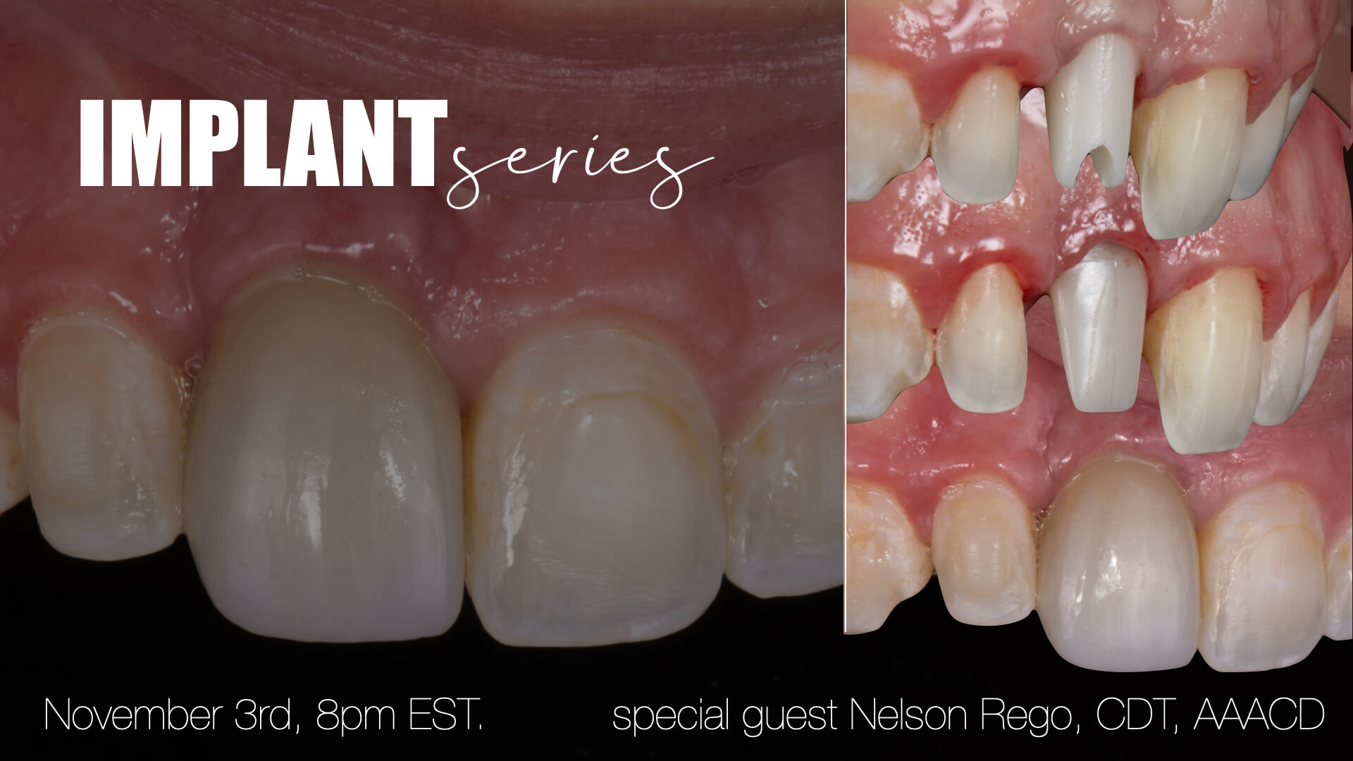 Implant Esthetics: Managing Tissue and Color Without Surgery