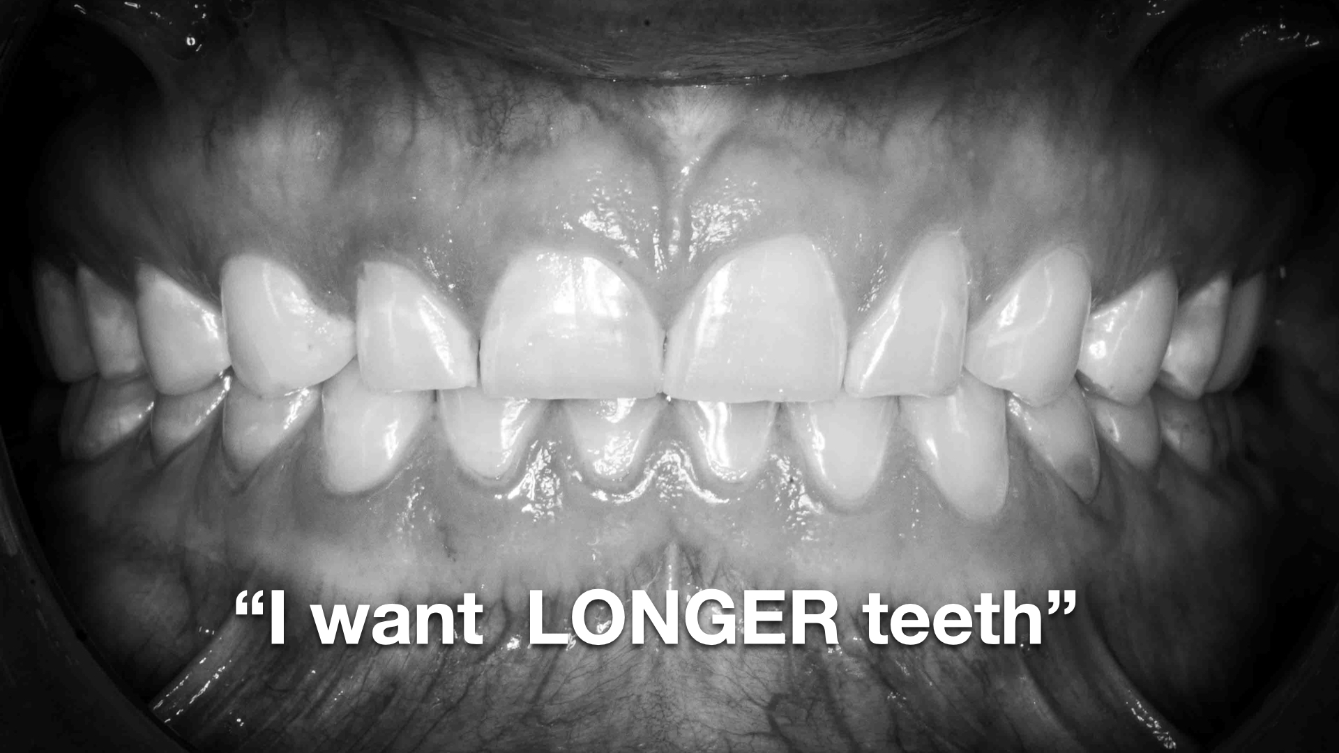 Achieving Longer Teeth Through Comprehensive Dental Restoration