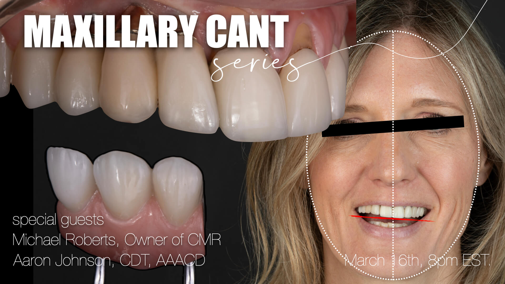 March Case Discussion: Maxillary Cant Series: A case that pushed every level of diagnosis and planning