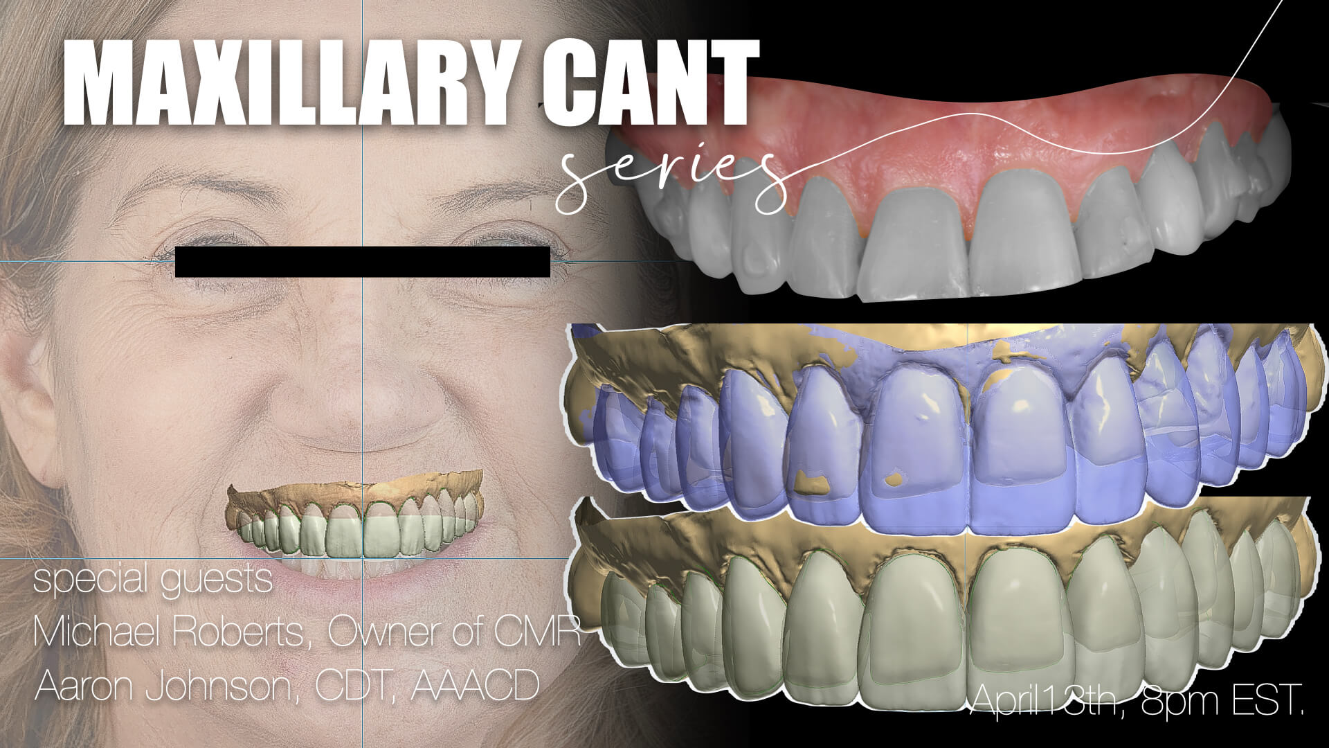 Designing Around Asymmetry: Restorative Strategy in a Severe Skeletal Cant