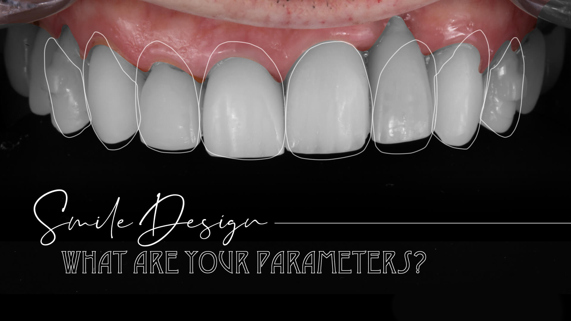 Smile Design: What are Your Parameters?