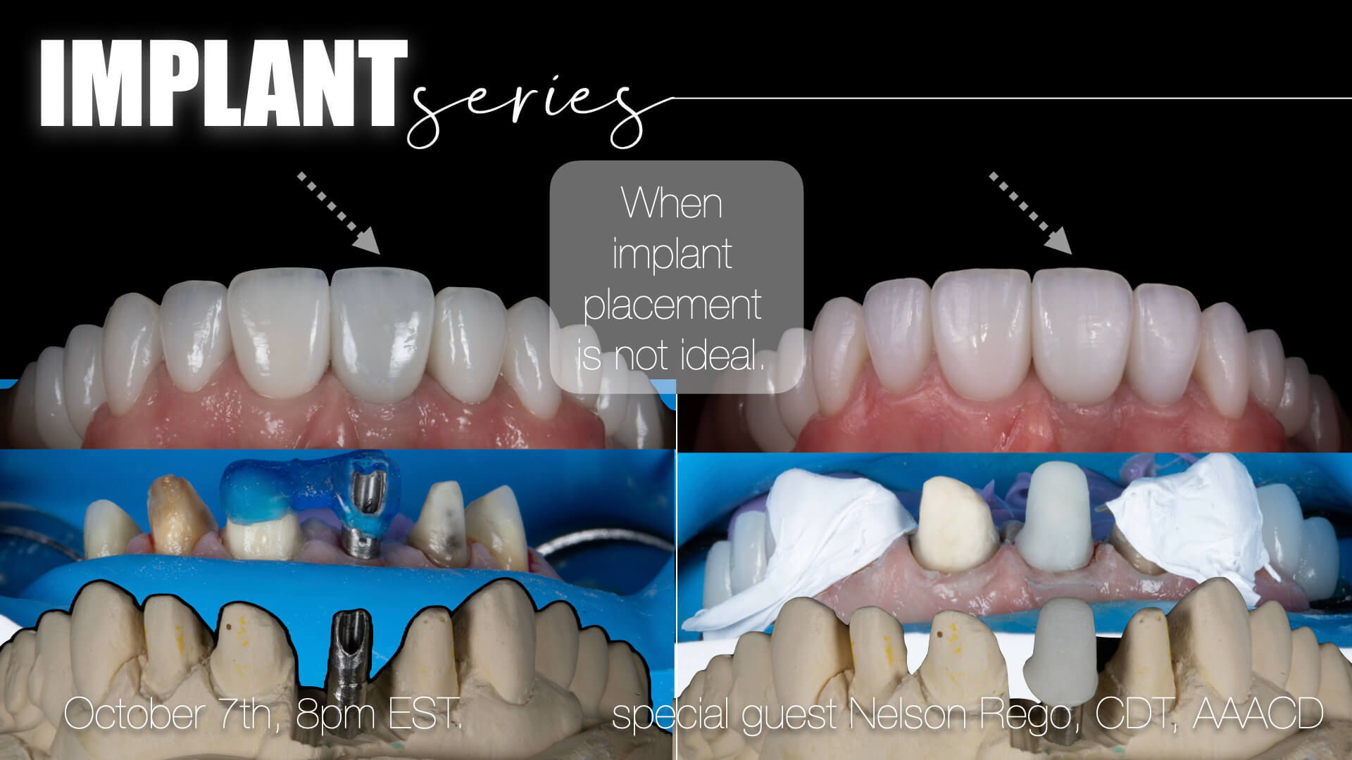 Implant Series: When Implant Placement is Not Ideal