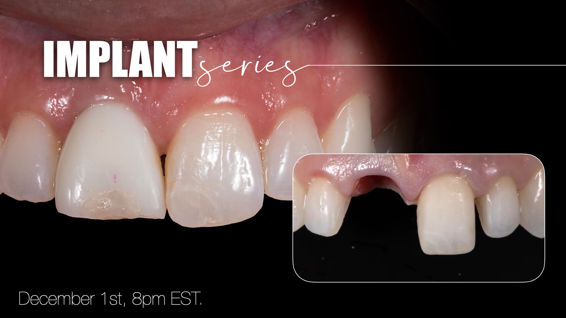 Implant Series: Managing Shade in Provisional Restorations