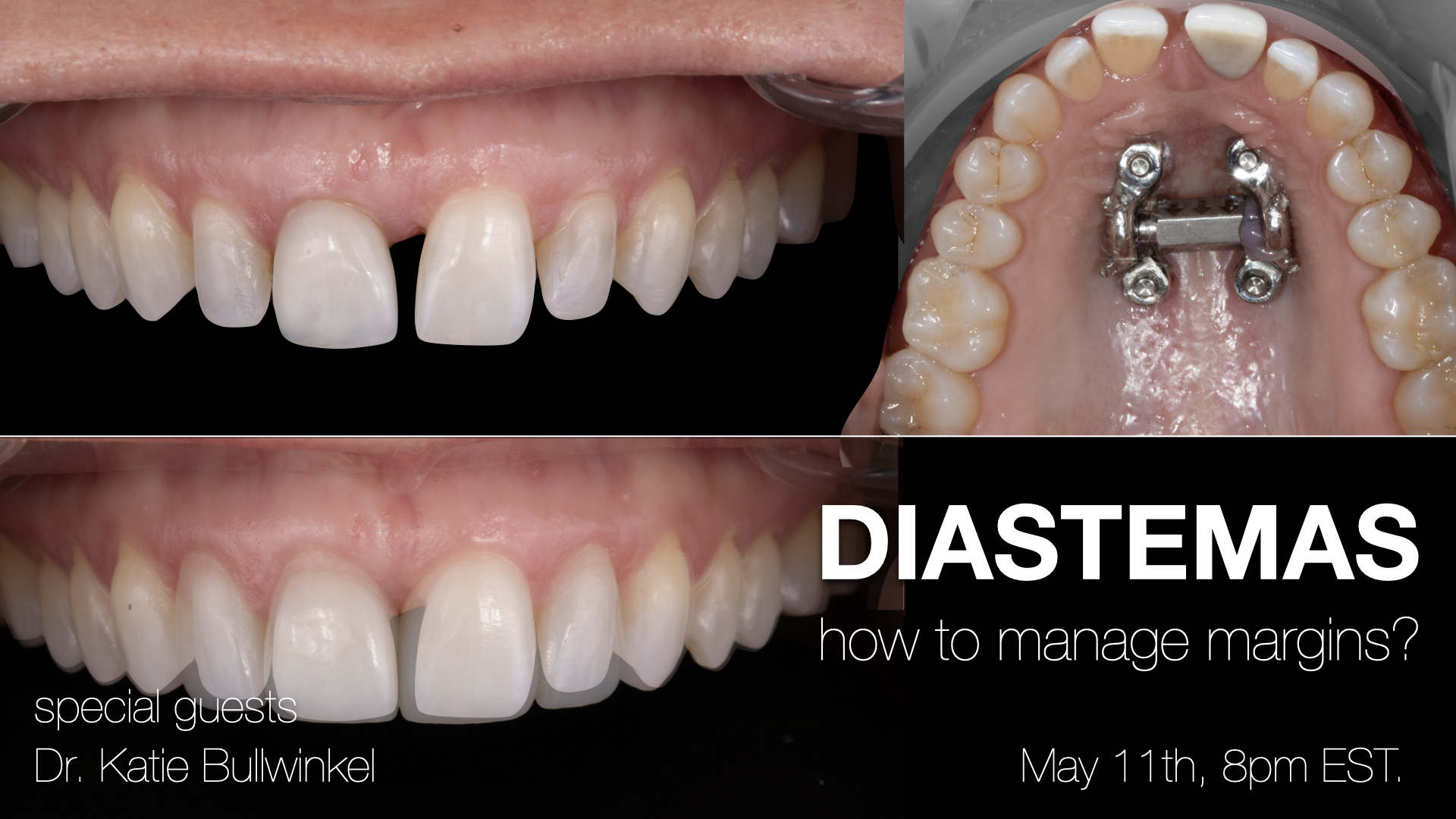 Diastemas: How to Manage Margins?