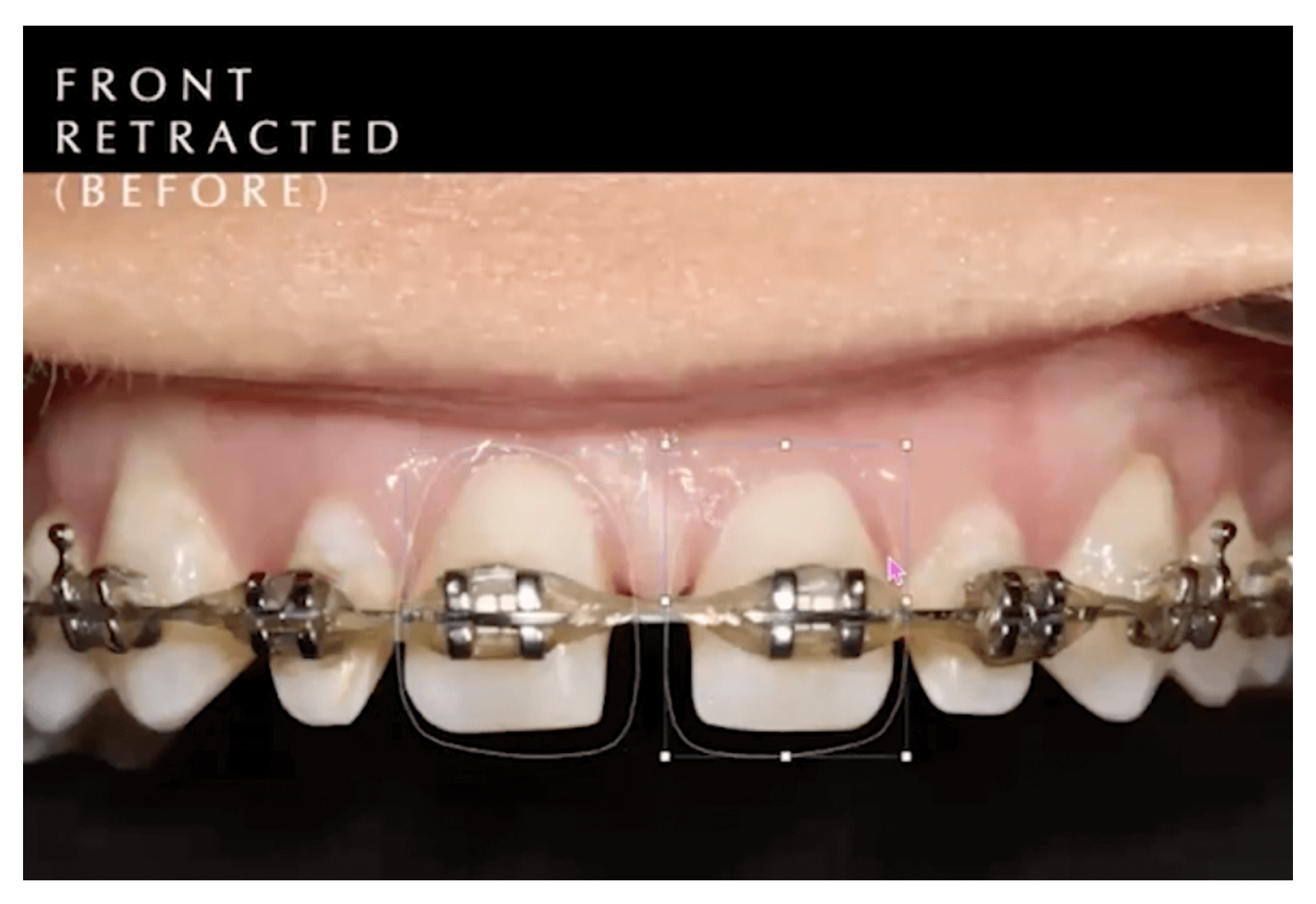 Managing Spacing Across the Entire Upper Arch: Minimally Invasive and Cost-Effective Approaches
