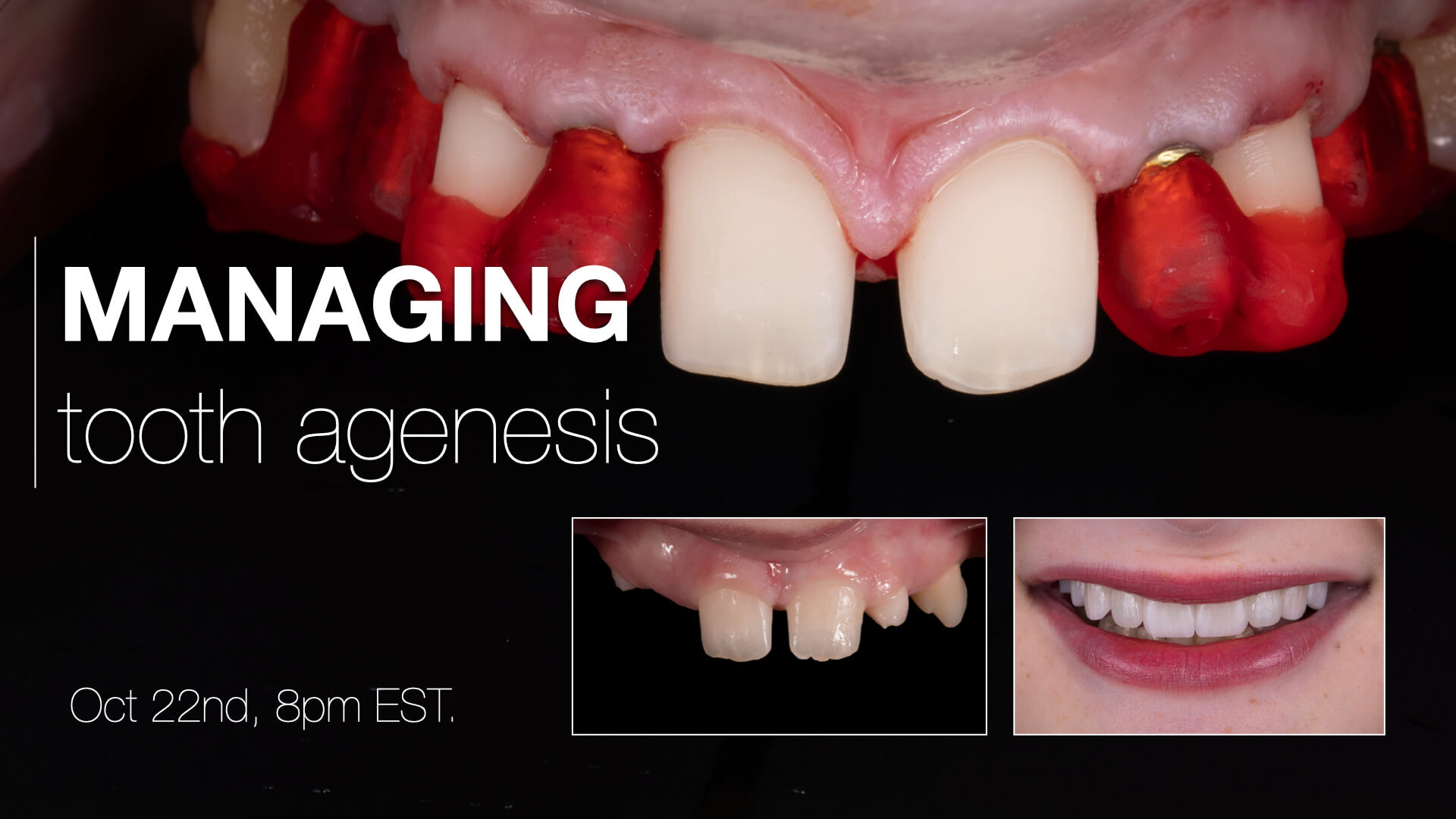 Managing Tooth Agenesis