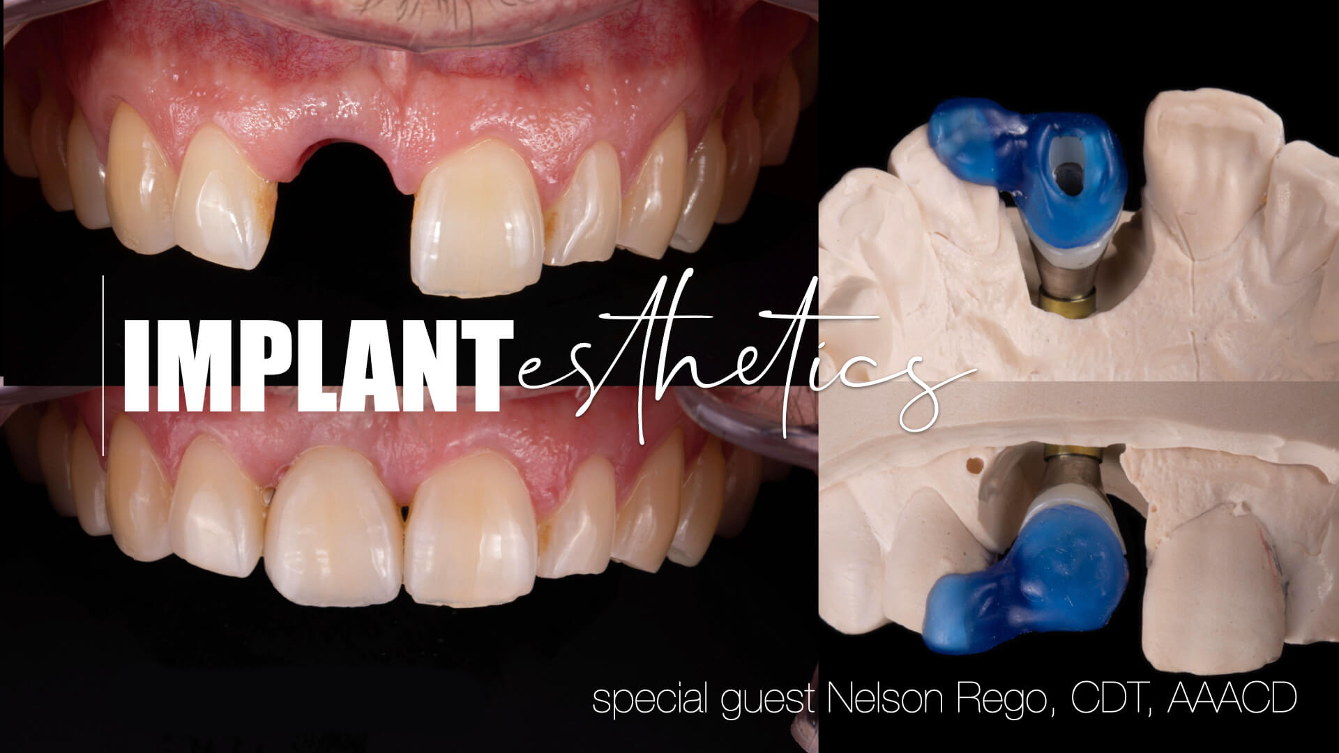 Implant Esthetics: Managing the Single Tooth Challenge