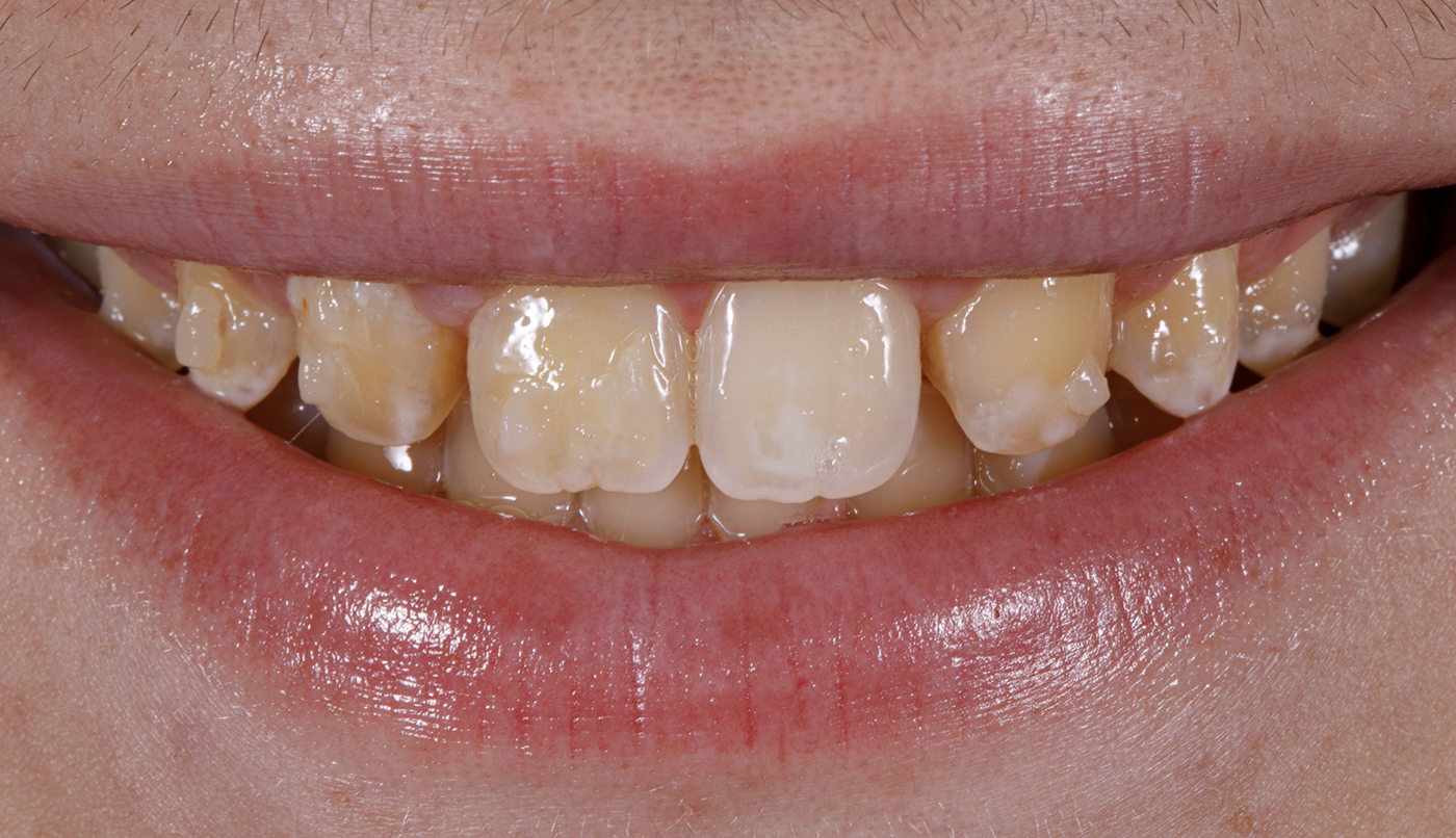 Canine Substitutions Present Esthetic Challenges