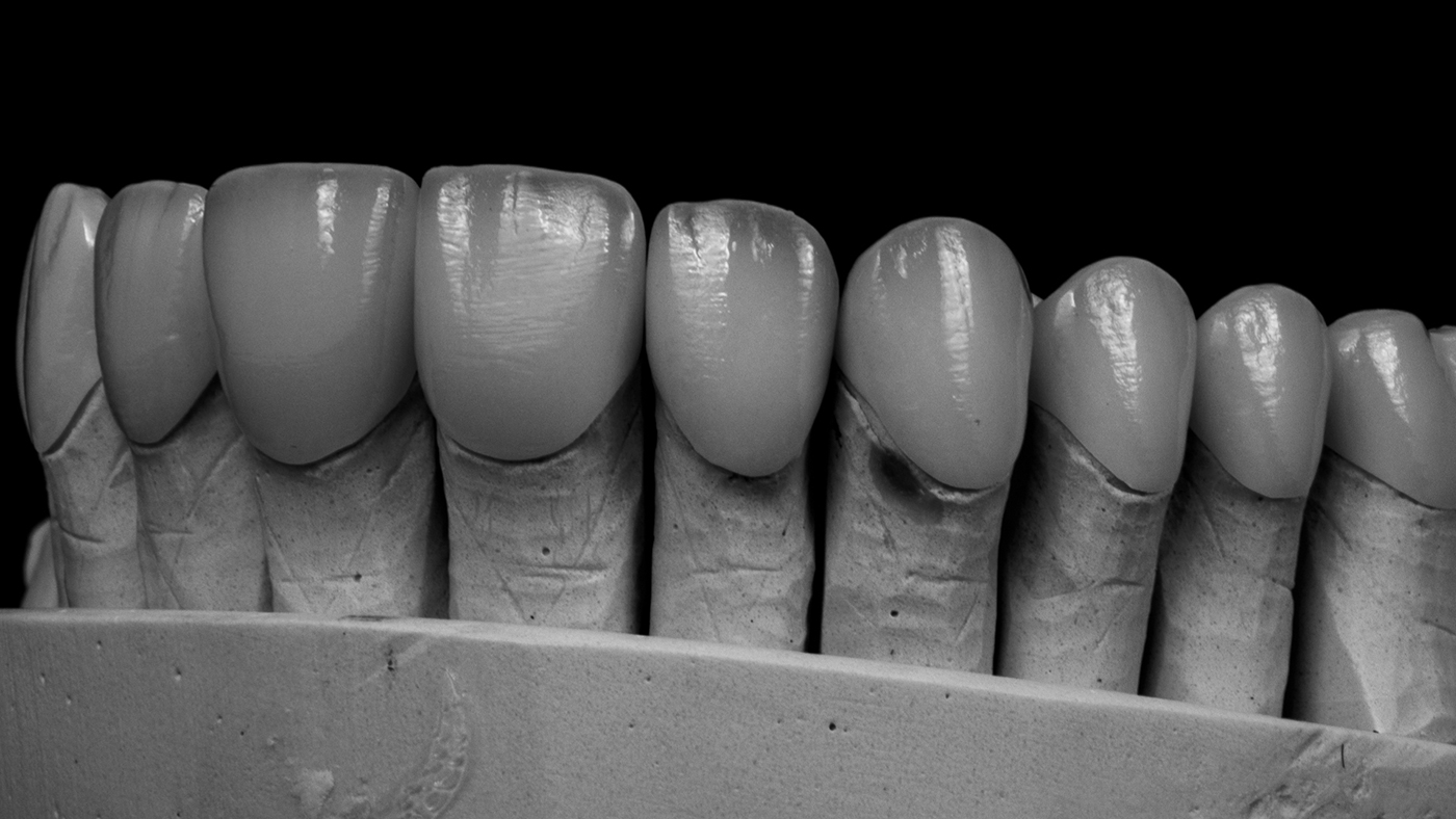 Elevating Smiles with Virtually No-Prep Veneers