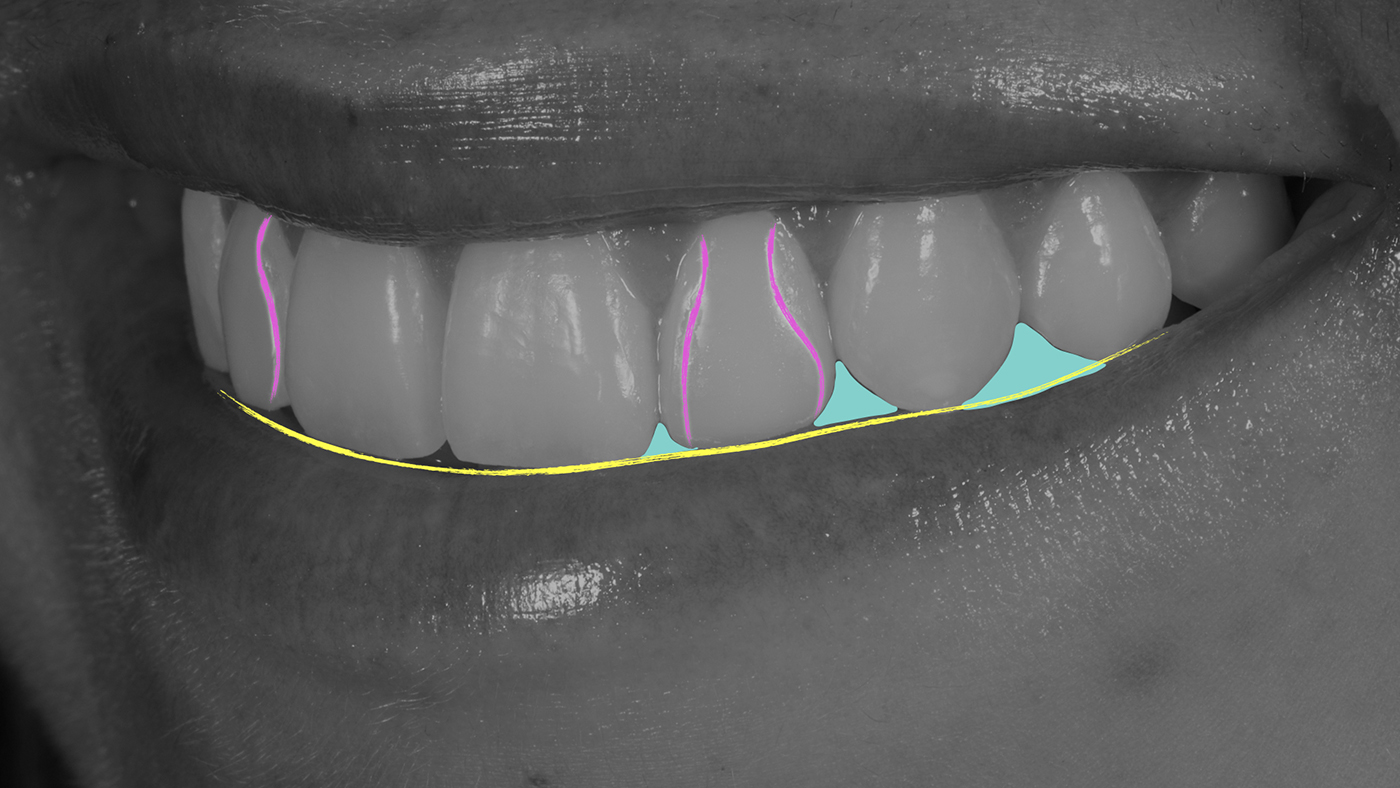 Grasp Natural Tooth Morphology