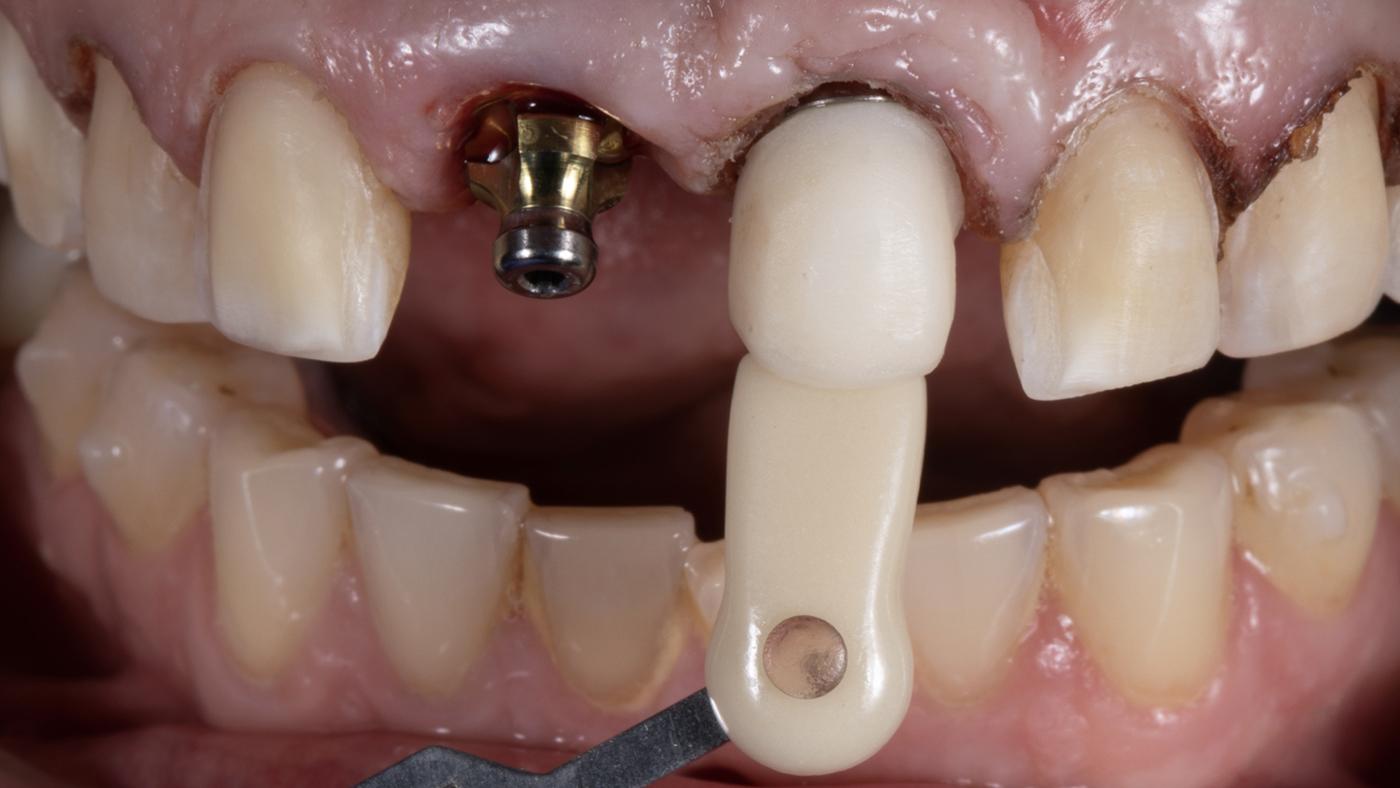 Implant Abutment Integration in Smile Makeover