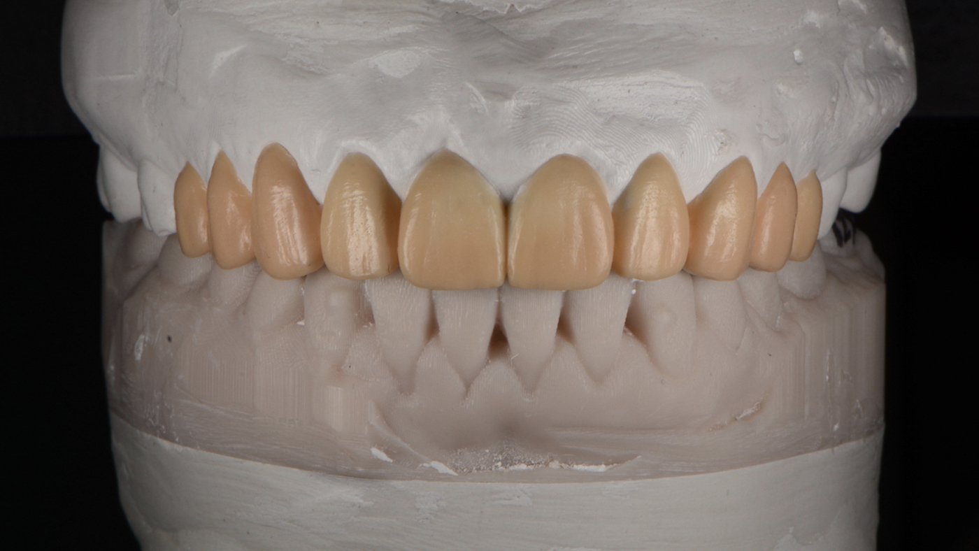 Lengthen & Widen the Smile