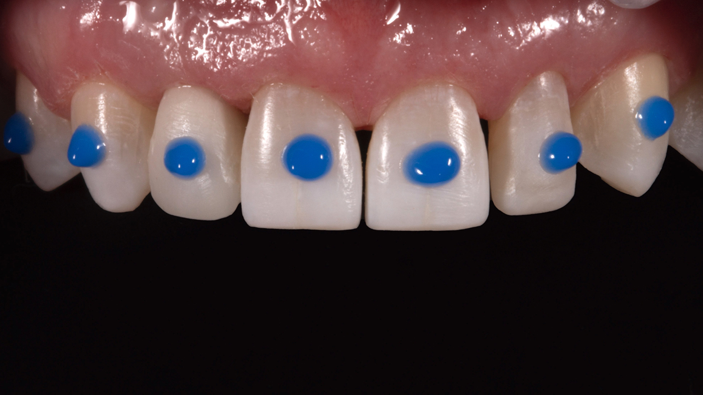 Minimally Invasive Veneer Prep
