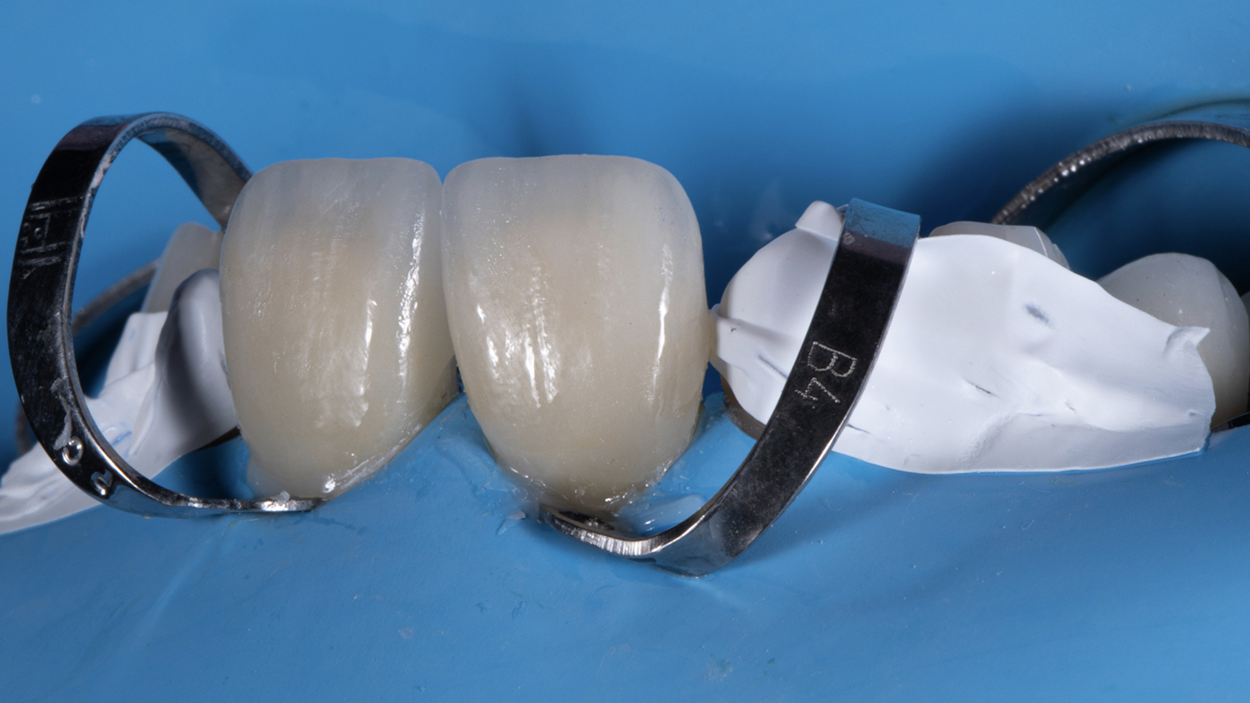 Planning for Four Restorations