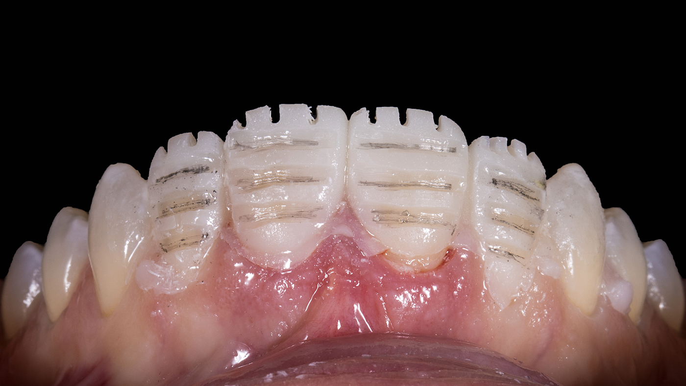 Planning for Four Veneers