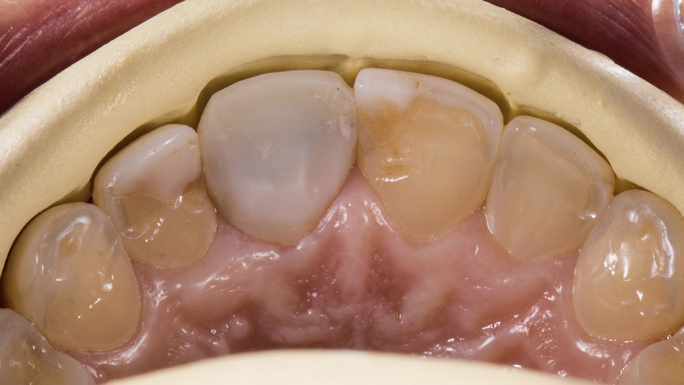 Precision in Tooth Reduction Assessment