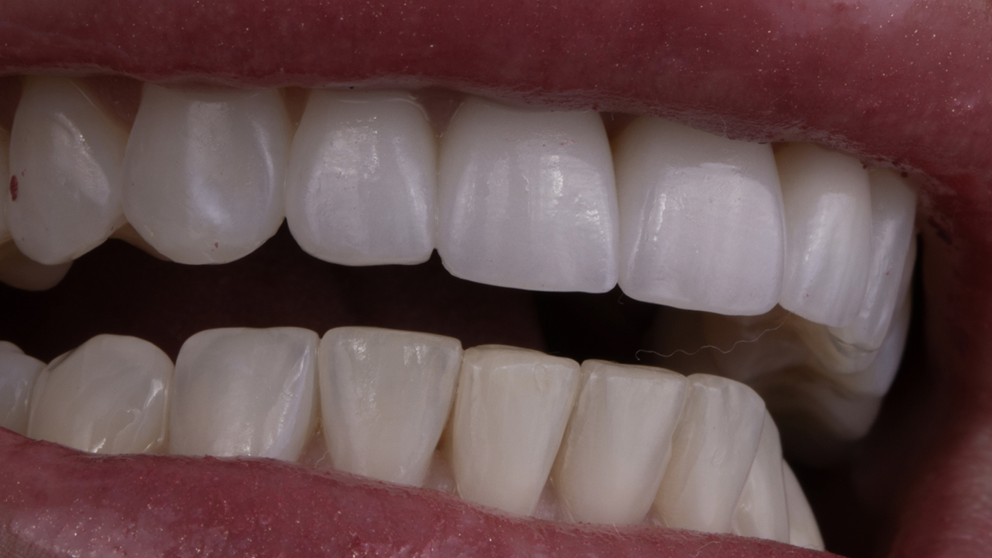 Unmasking Tooth Transformations
