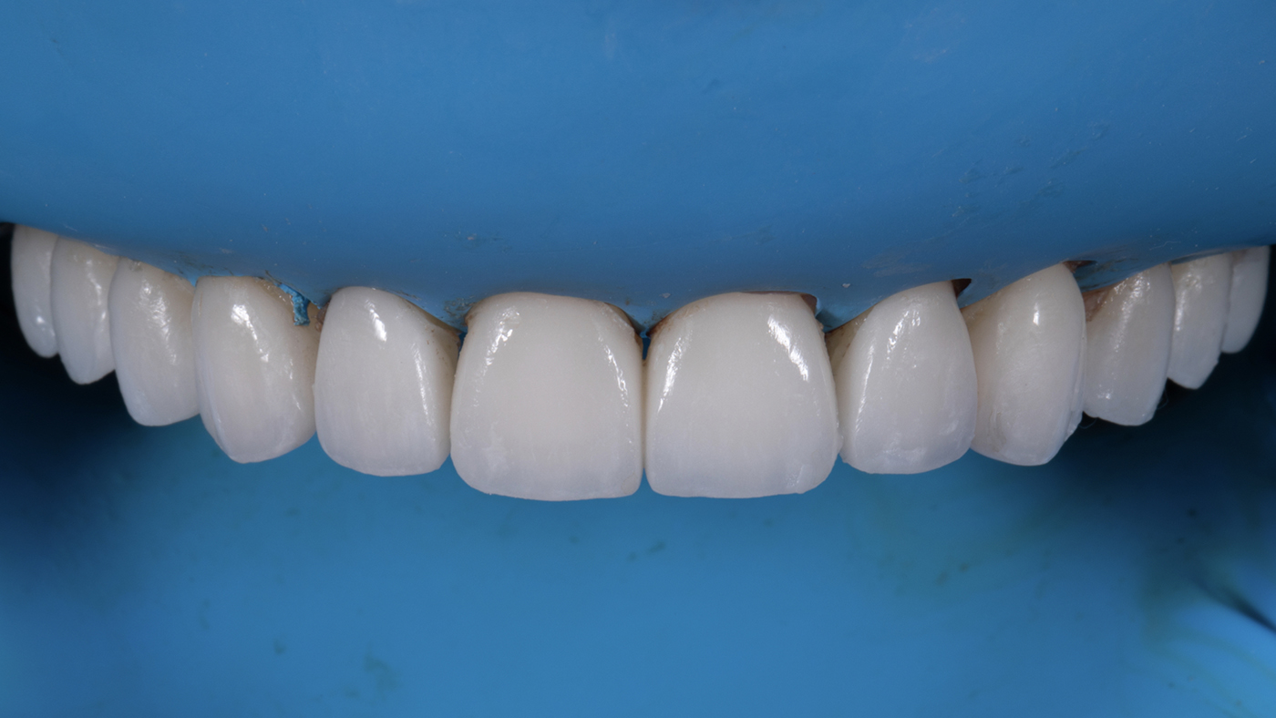 Veneer Enhancement Opportunities with Aligners