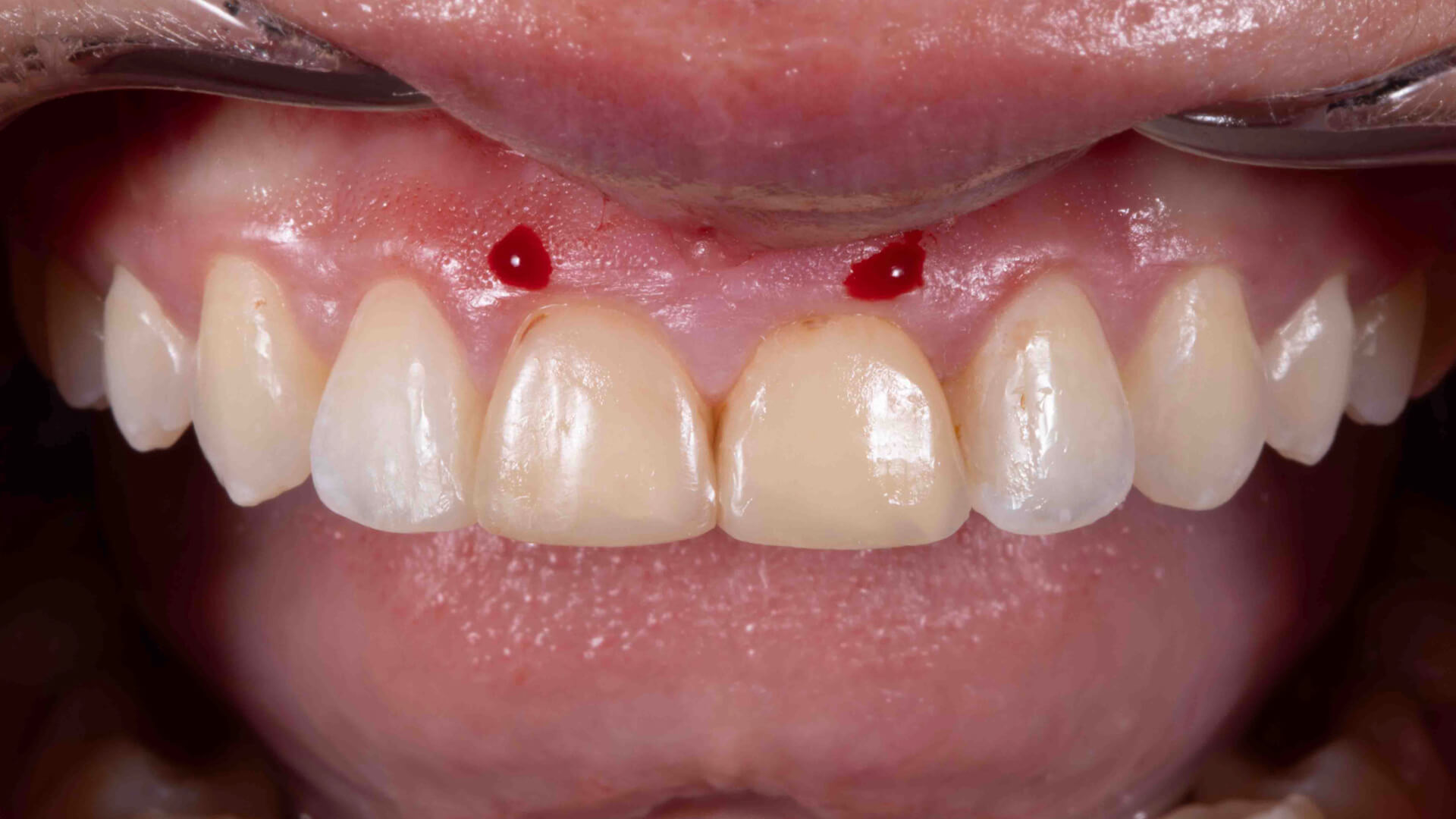 Achieving a Balanced Smile with Same-Day Crown Lengthening and Veneers