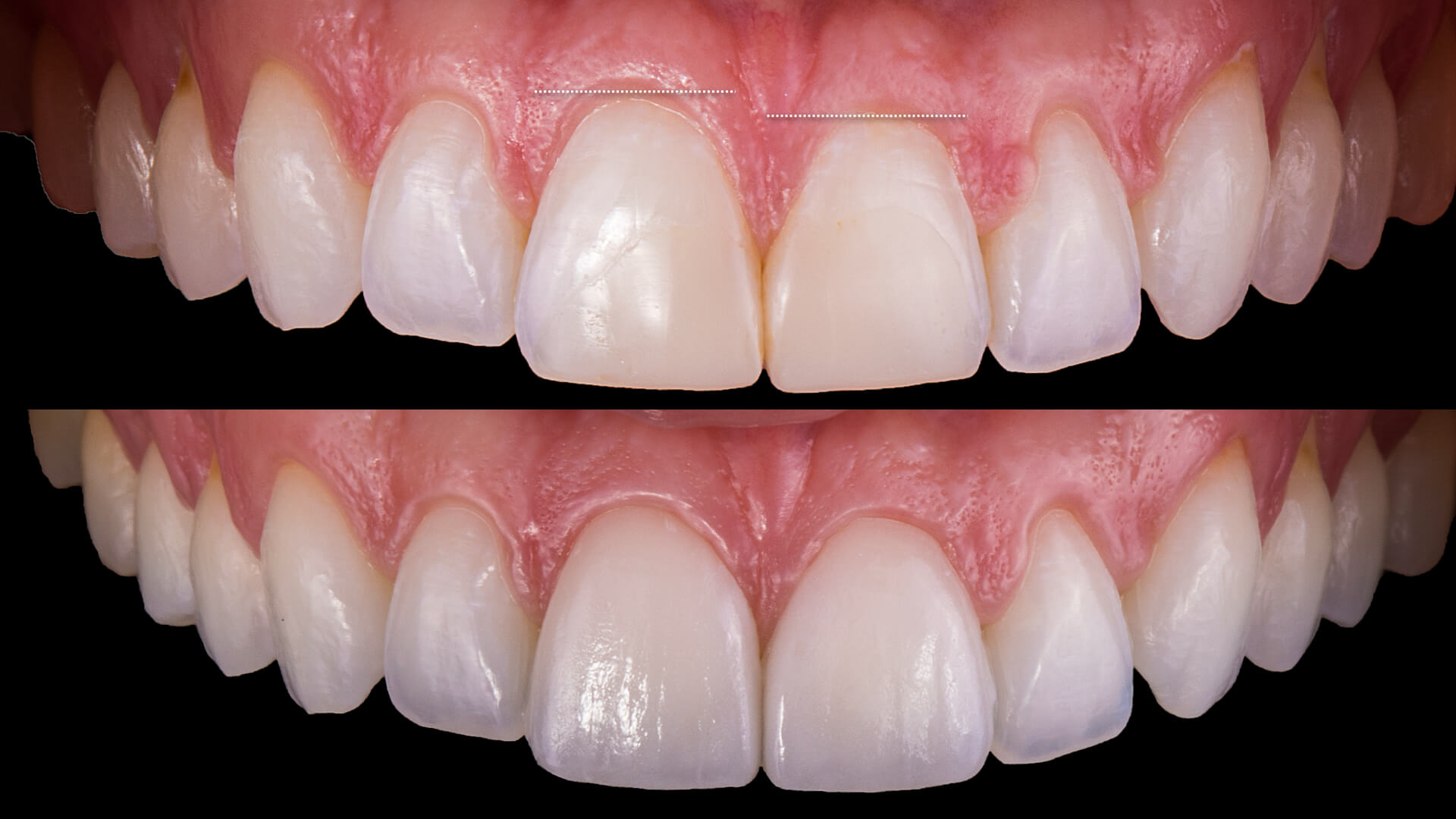 Replacing Old Bonding with Porcelain Veneers