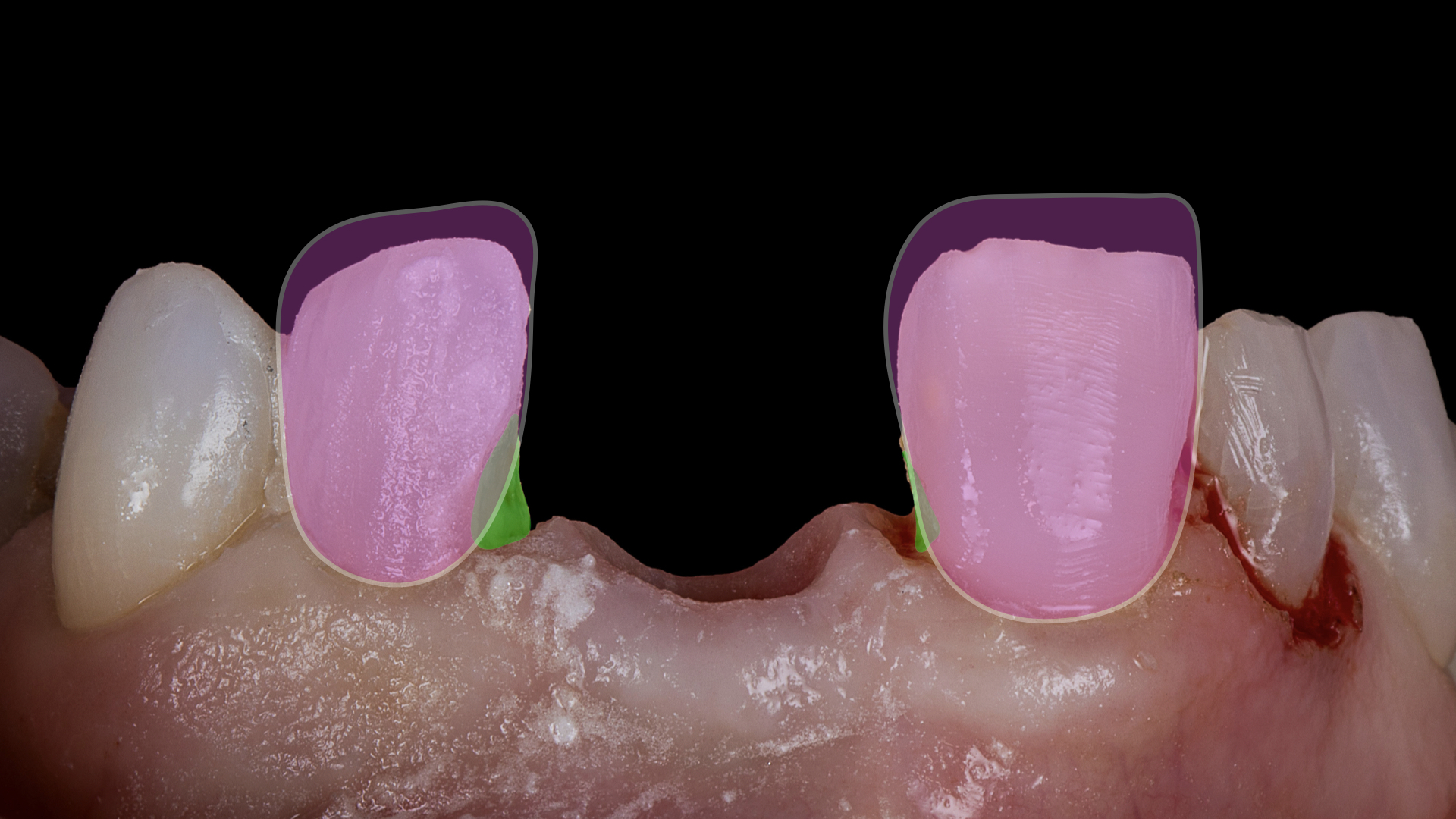 Managing Undercuts in Veneer Preparations