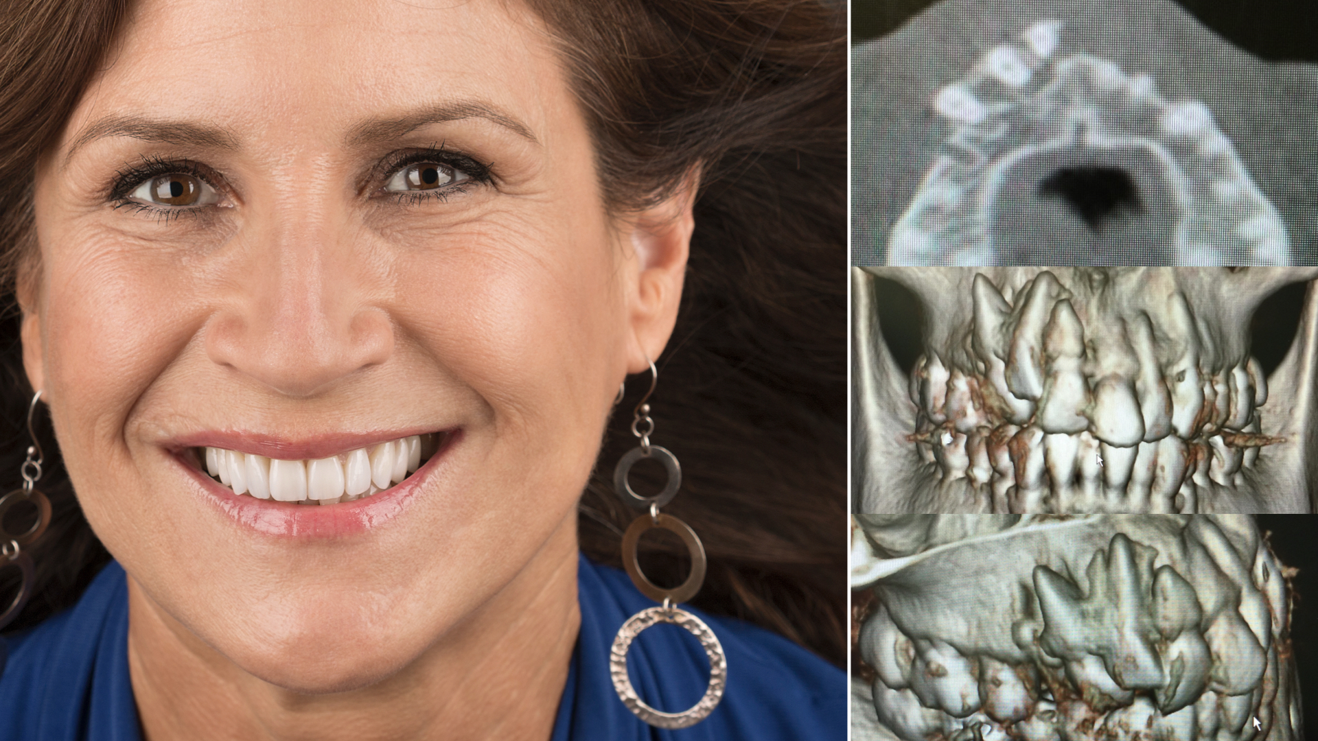 Treating Dental Trauma: Realistic Solutions After Avulsion