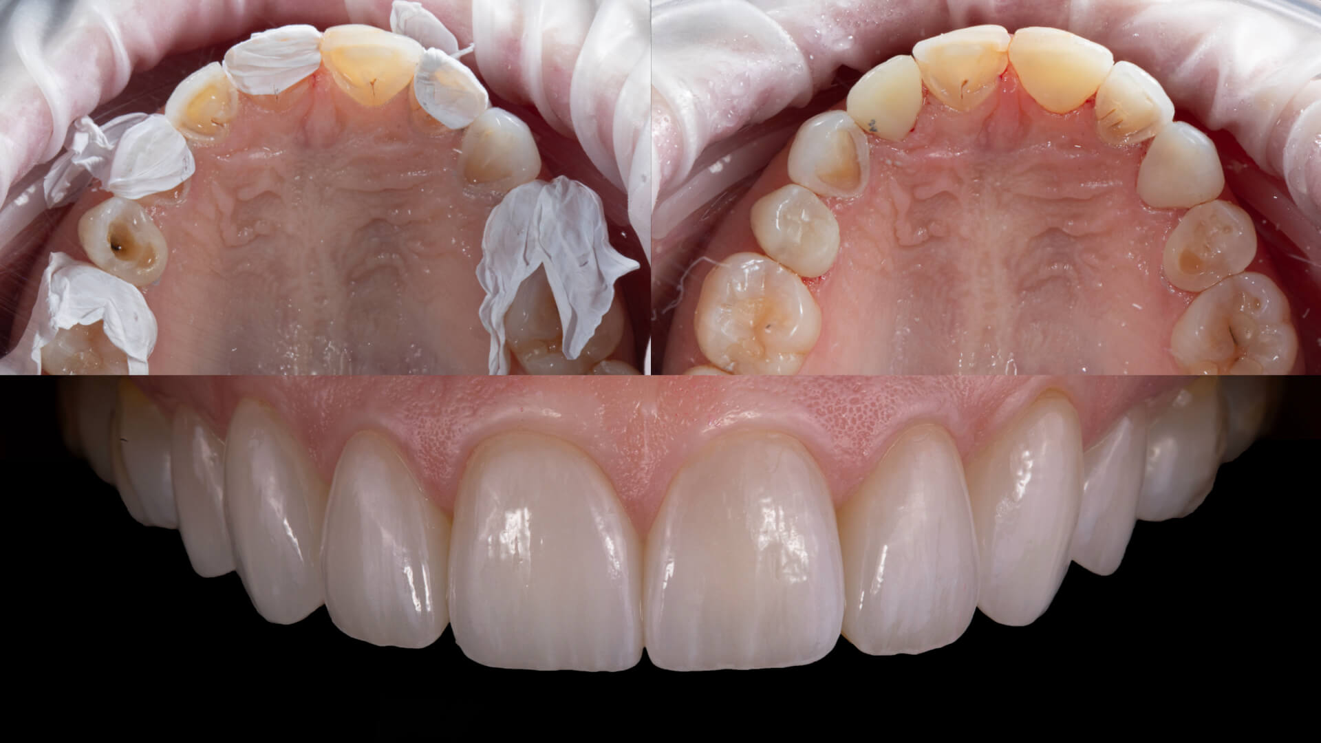 Restoring Severely Eroded Teeth