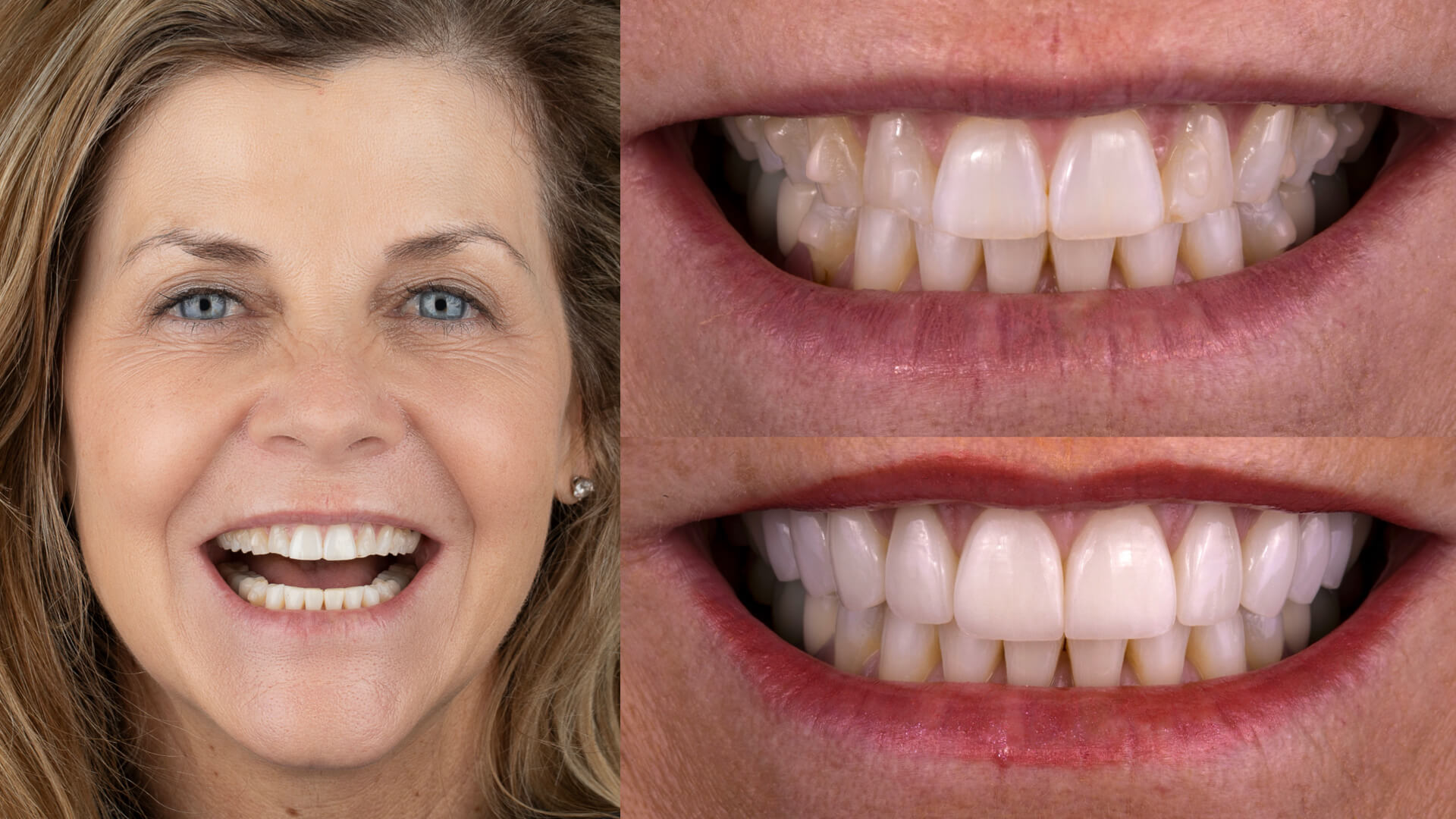 Using Invisalign to Correct Worn Teeth
