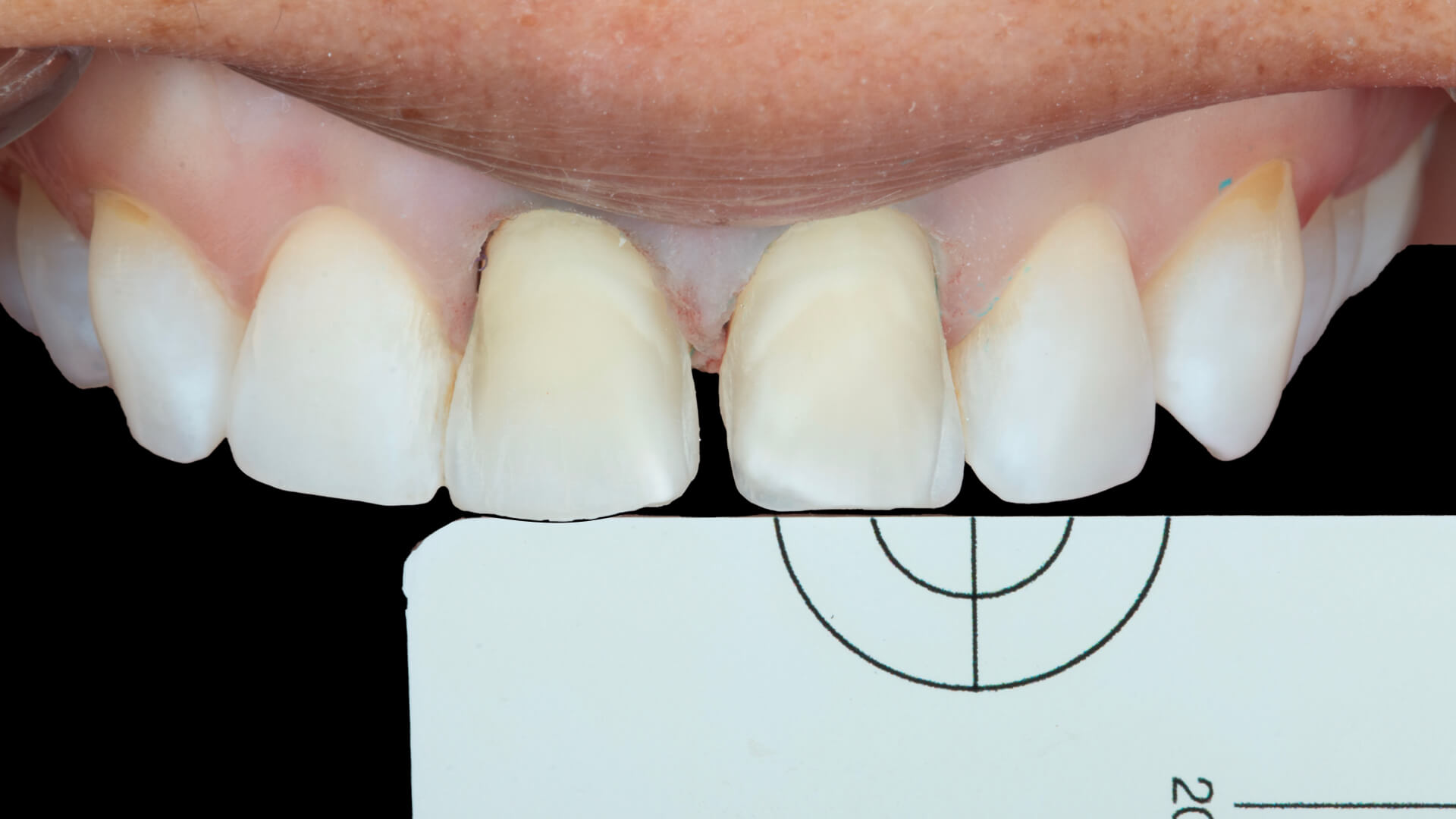 Addressing Two Teeth