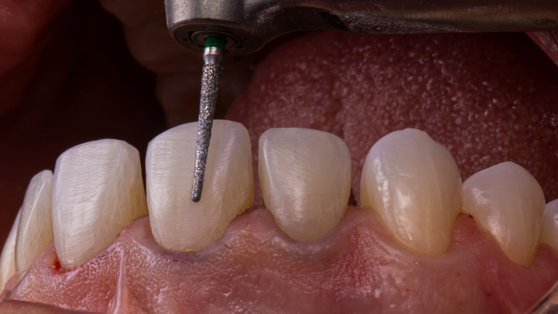 Enhancing Function and Esthetics with Aligners