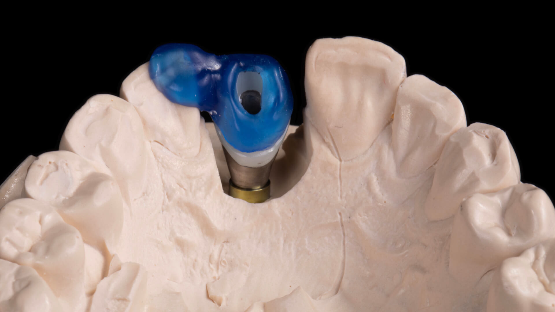 Single-Tooth Restorations: Overcoming Challenges