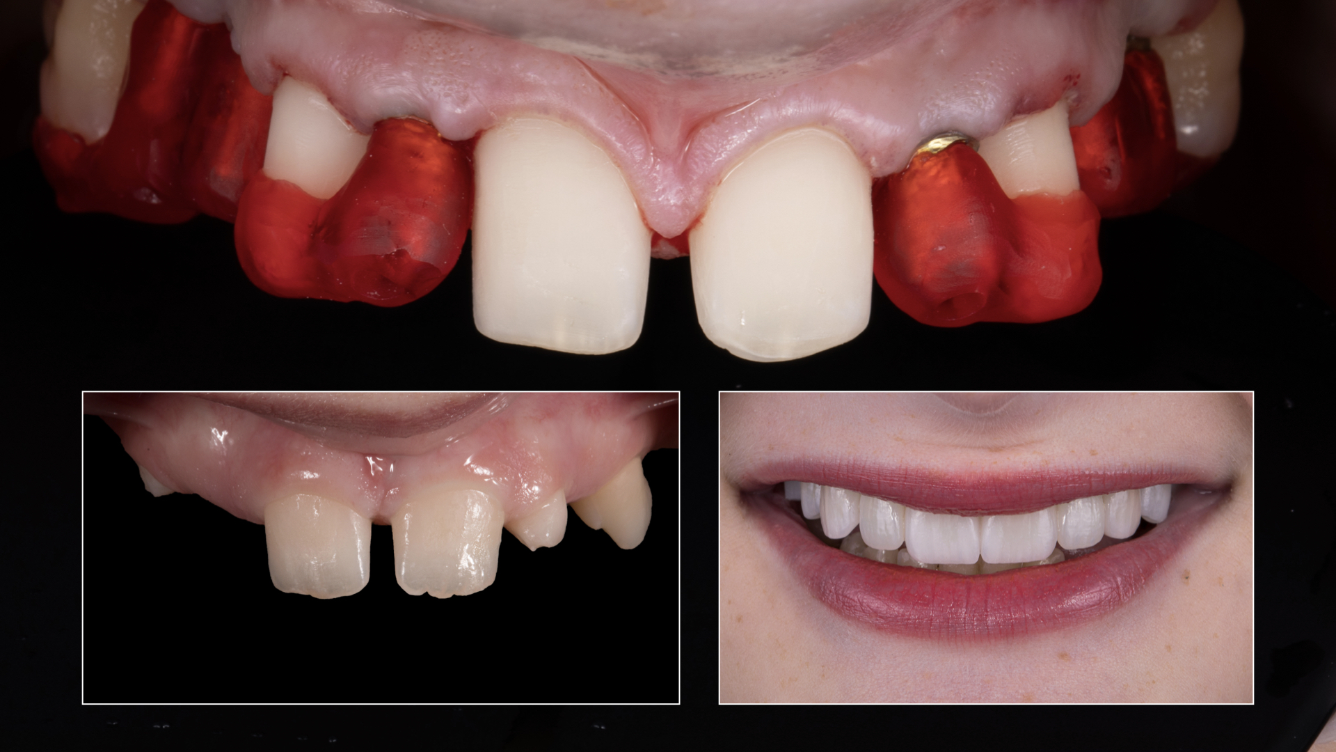 Managing Agenesis: From Orthodontics to Restorative Care