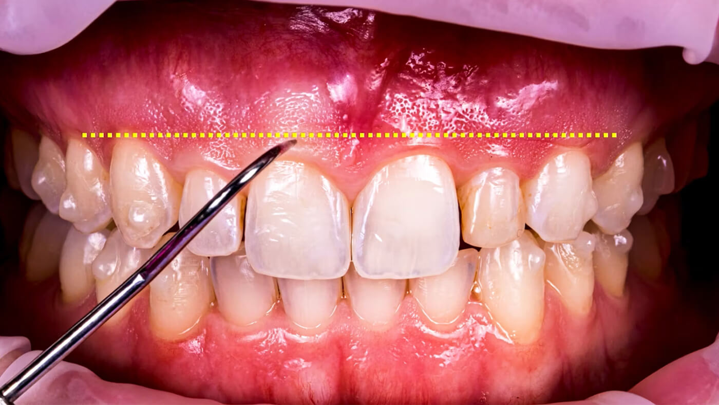 Crown Lengthening