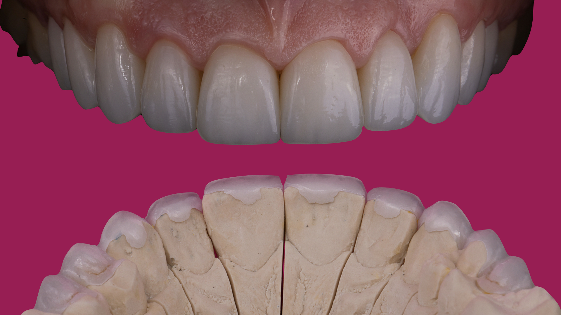 Mastering Minimally Invasive Veneers