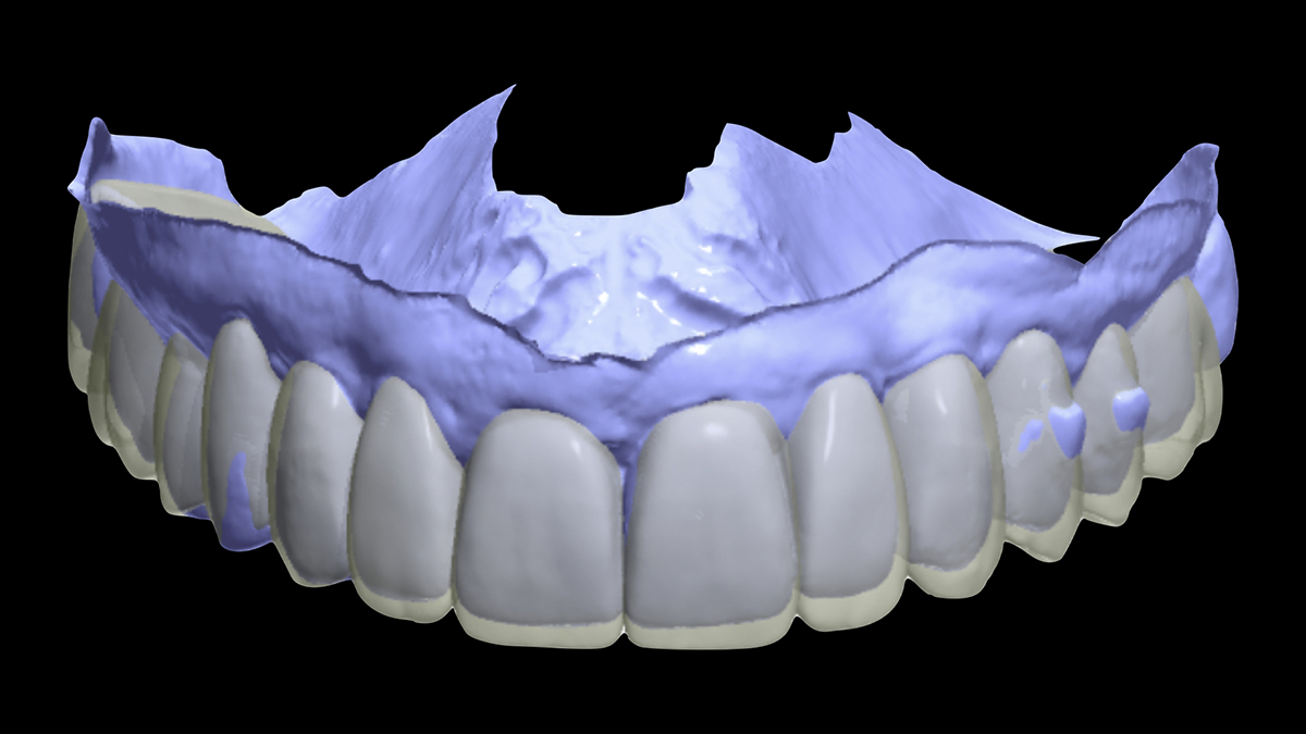 Orthodontic-Restorative Synergy in Retreatment